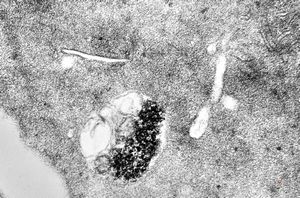 M,24y. | bone marrow - haemolytic anemia M,24y. | bone marrow - haemolytic anemia